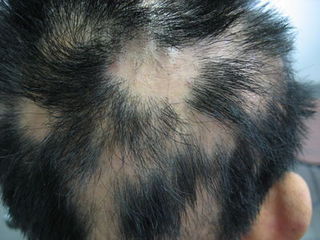 斑秃有哪些常见的症状
