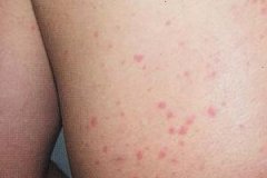 皮肤瘙痒的病因是什么