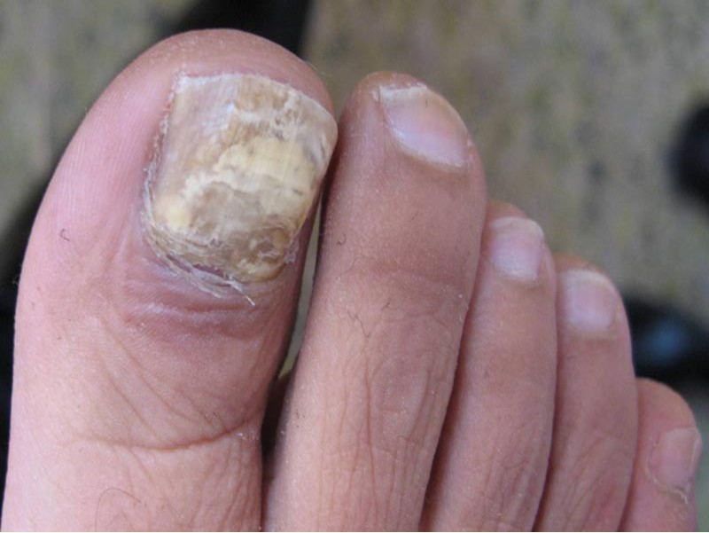 得了灰指甲会导致出现哪些症状